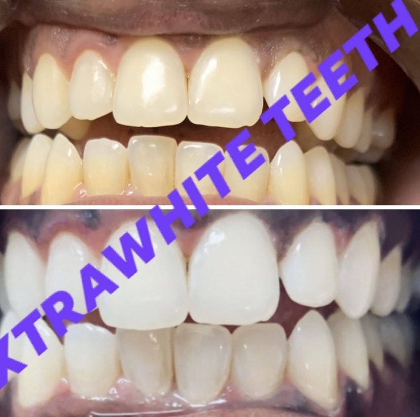 XtraWhite Teeth