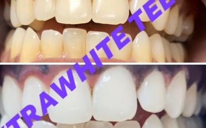 XtraWhite Teeth XtraWhite Teeth