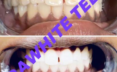 XtraWhite Teeth XtraWhite Teeth